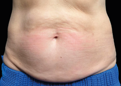 BEFORE TREATMENT