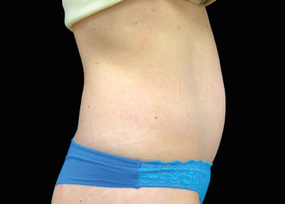 BEFORE TREATMENT